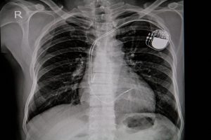 Xray of a pacemaker